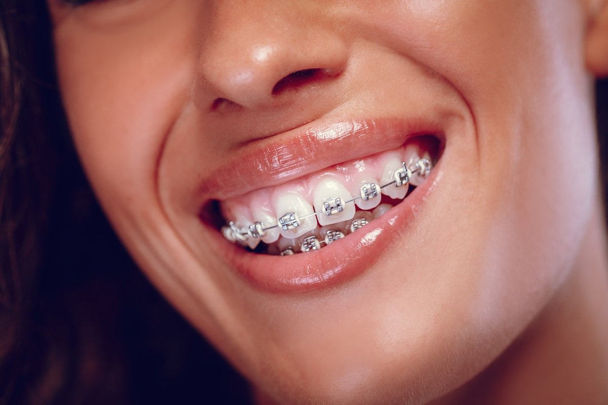 smiling-woman-showing-teeth-with-metal-braces-2026-01-05-22-53-56-utc.jpg