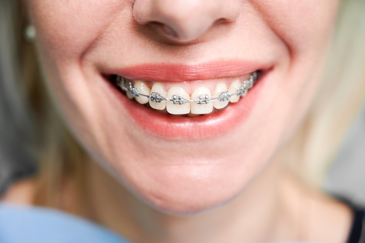 smiling-woman-showing-teeth-with-metal-braces-2026-01-09-00-03-08-utc.jpg